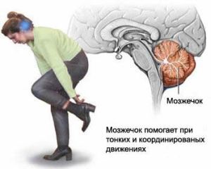 Anomalie arnold chiari 1, 2, 3 grade - tratament și simptome