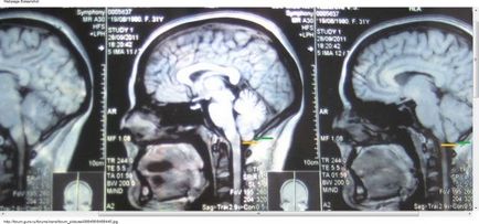 Anomalie arnold chiari 1, 2, 3 grade - tratament și simptome