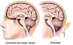 Аномалія Арнольда Кіарі 1, 2, 3 ступеня - лікування і симптоми