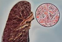 Anthracoză - cauze, simptome, diagnostic și tratament