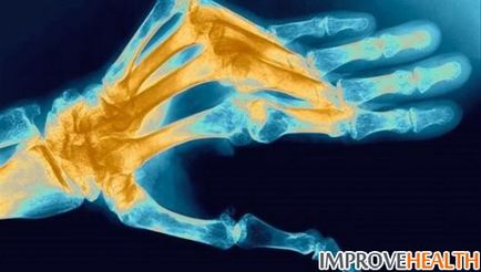 Arthritis okoz kefék, a kezek, a tünetek és a kezelési módszerek