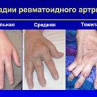 Артрит кистей рук причини, симптоми і способи лікування