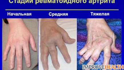 Arthritis причинява четки на ръцете, симптоми и методи на лечение