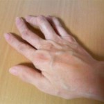 Artrita mâinilor și a simptomelor într-un stadiu incipient