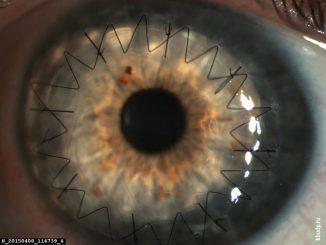 Belmo pe cauzele ochiului omului și tratamentul, opacitatea corneei, leucemia, tratamentul conservator