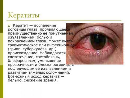 Belmo pe cauzele ochiului omului și tratamentul, opacitatea corneei, leucemia, tratamentul conservator