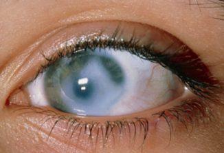 Більмо на оці у людини причини і лікування, помутніння рогівки, лейкома, консервативне лікування