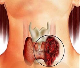 Sarcina după transplantul de rinichi, sarcină pentru femeile cu transplant renal