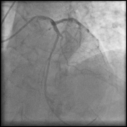 Bifurcația stentului arterelor coronare, separarea tehnicilor chirurgicale cu raze X