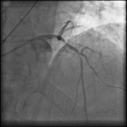 Bifurcația stentului arterelor coronare, separarea tehnicilor chirurgicale cu raze X