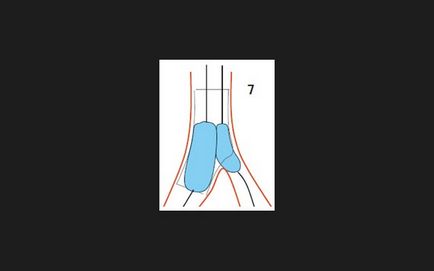 Bifurcație tehnician de examinare stenting, doc2doc