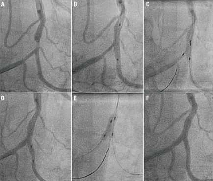 Bifurcație tehnician de examinare stenting, doc2doc