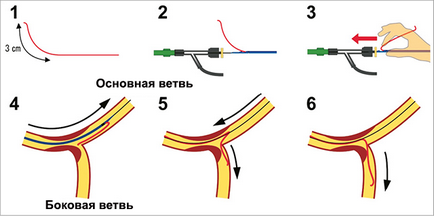 Bifurcație tehnician de examinare stenting, doc2doc