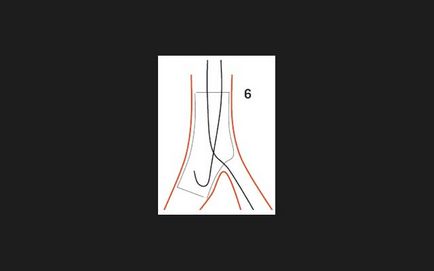 Bifurcație tehnician de examinare stenting, doc2doc