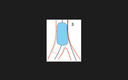 Bifurcație tehnician de examinare stenting, doc2doc