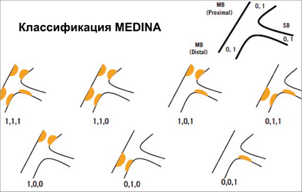 Біфуркаційних стентування огляд технік, doc2doc