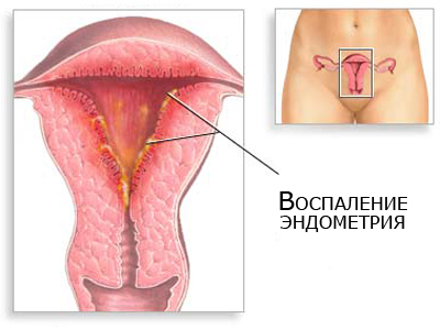 Betegségek az endometrium a méh - azaz, a tünetek, a kezelés
