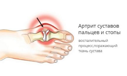 Durere la nivelul articulațiilor cauzate de cauze mari și alte degete, simptome, tratament