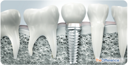 Какво е различен от щифт имплант