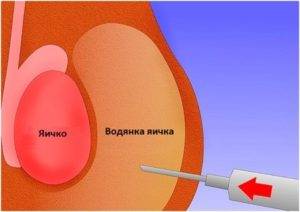 Ce este această boală - o picătură de testicul, ceea ce este periculos este boala de picături (hidrocefalie), simptome, cauze