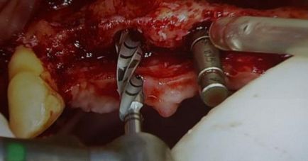 Ce este necesar pentru implantarea dinților, implantarium