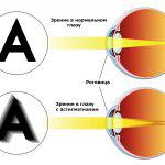 Care este astigmatismul ochilor la adulți cu simptome și tratament, semne și cauze, este posibil să se vindece
