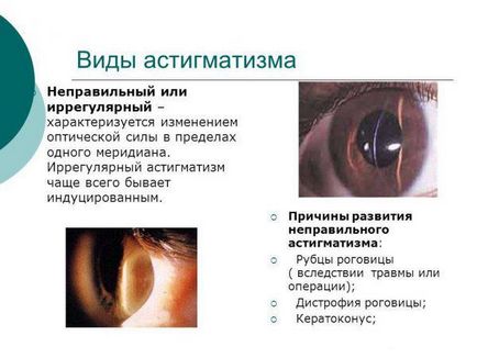 Care este astigmatismul ochilor la adulți cu simptome și tratament, semne și cauze, este posibil să se vindece