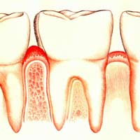 Десна відійшла від зуба що робити, як лікувати
