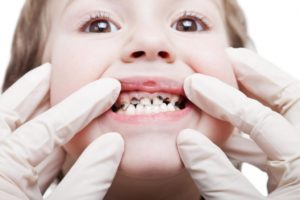Diagnosticul cariilor dentare