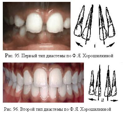 Diastema - ortodonție, anomalii dentare - chirurgie și tratament