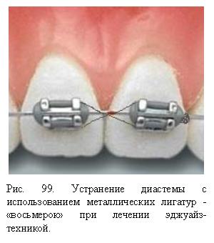 Diastema - ortodonție, anomalii dentare - chirurgie și tratament