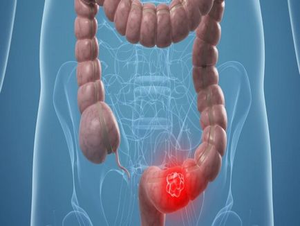 Diverticuloza simptomelor colonului sigmoid și tratament