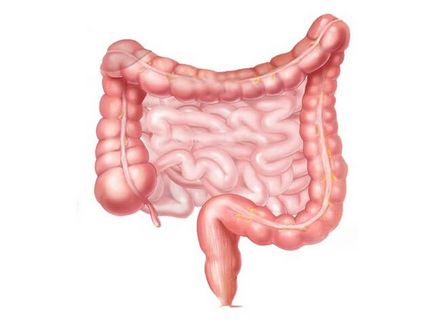 Diverticuloza simptomelor colonului sigmoid și tratament
