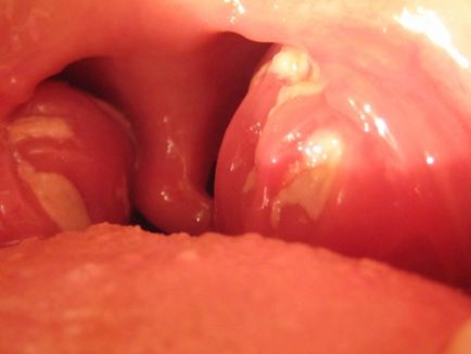 Remedii eficiente pentru dureri în gât, cum să vindeciți angină cu remedii folclorice