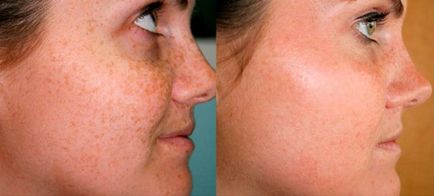 Crema eficientă pentru petele pigmentare de pe față