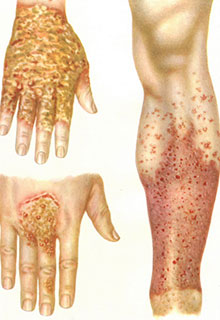 Eczemă pe mâini - clinica homeopatică 