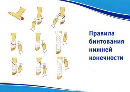 Bandaj elastic cu tromboflebită și varicoasă cum să bandajați piciorul, tratamentul varicelor