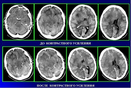 Astrocitom fibrilativ al tratamentului cerebral, prognostic