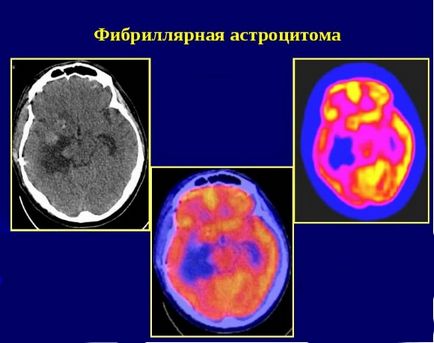 Фібрилярна астроцитома головного мозку лікування, прогноз