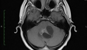 Fibrilláris agyi asztrocitóma prognózist (fej) Rostos agyi astrocytoma előrejelzése