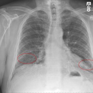 Fibroza plămânilor este ceea ce este și cum se tratează, simptomele fibrozei pulmonare și tratamentul