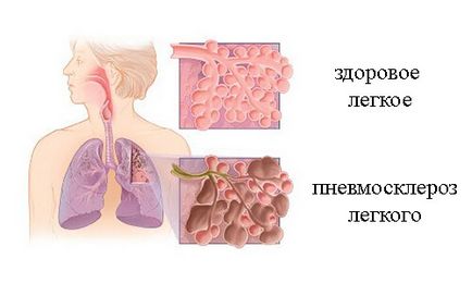 Fibroza plămânilor este ceea ce este și cum se tratează, simptomele fibrozei pulmonare și tratamentul