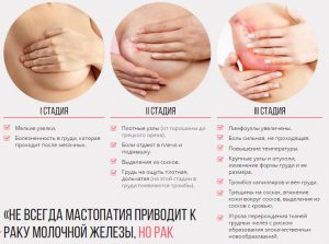 Fibro cisztás mellbetegség fő tünetek és a kezelés (kezelés) Fibro cisztás mellbetegség fő tünetek és a kezelés