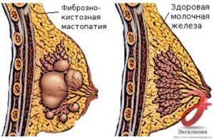 Fibro cisztás mellbetegség fő tünetek és a kezelés (fibro) Fibro cisztás mellbetegség fő tünetek és a kezelés