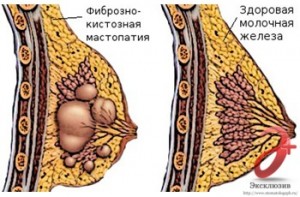 Mastopatie chistică fibroasă Simptome majore și tratament