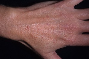 Фототоксическая реакція шкіри - причини, діагностика, лікування