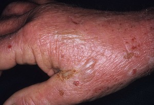 Фототоксическая реакція шкіри - причини, діагностика, лікування