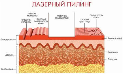 Фракційний пілінг особливості процедури