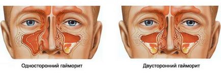 Locația sinusurilor Gaimorovy și unde sunt acestea, care sunt cauzele apariției durerii