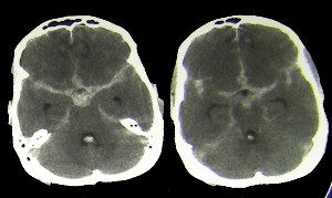 Semnele hemoragice de accident vascular cerebral și cauzele de dezvoltare la om